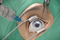 Augenarztpraxis Karsta Rehfeldt  - Medikamenteneingabe in den Glaskörperraum